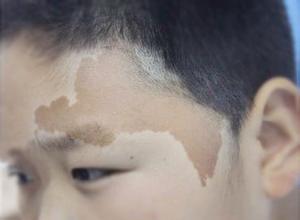 上海咖啡斑胎记医院_武警上海浦东医院[胎记专科]